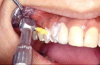歯科衛生士によるPMTC（プロフェッショナル・メカニカル・トゥース・クリーニング）3