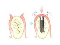 インプラント一次手術