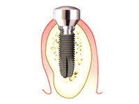 インプラント二次手術