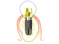 インプラント人工の歯を作製・装着