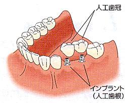 インプラント