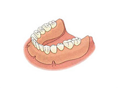 義歯（入れ歯）