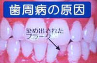 歯周病になると･･･