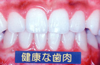 歯周病になると･･･1