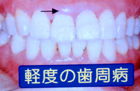 歯周病になると･･･2