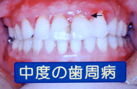 歯周病になると･･･3