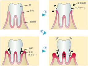 歯周病になると･･･4