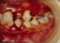 歯周病になると･･･before