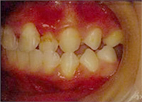 歯周病になると･･･after